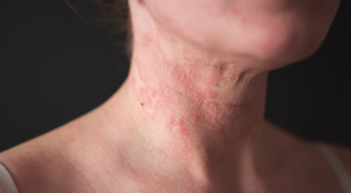 אטופיק דרמטיטיס